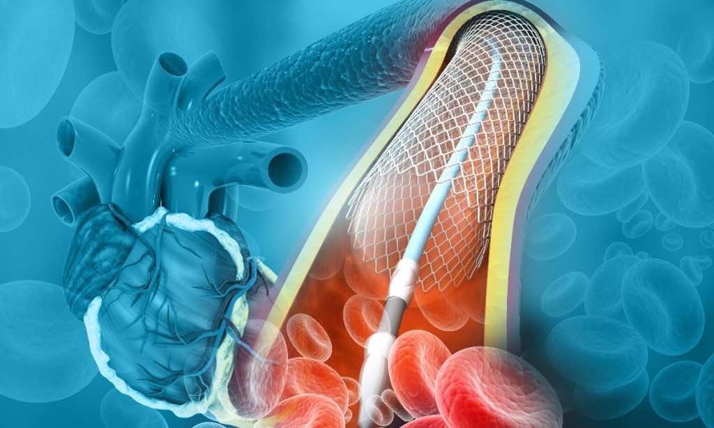 Pharmedio Naczynia wieńcowe serce krwinki stent śródbłonek naczyniowy stent miażdżyca