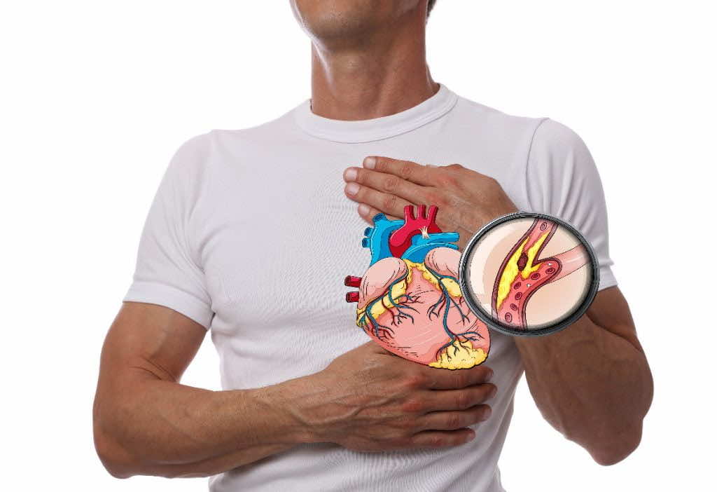 Pharmedio układ krążenia serce naczynia wieńcowe cholesterol dyslipidemia