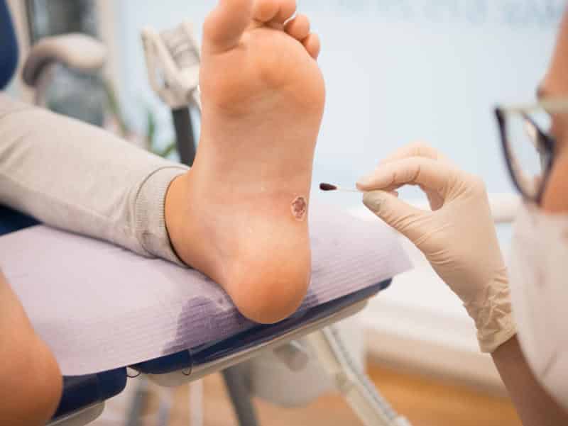 Brodawki kurzajki dermatolog stopy wymrażanie